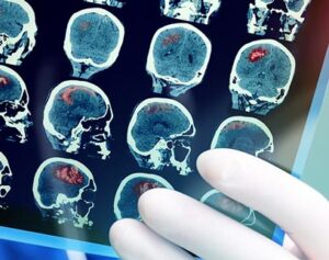 Glendale Traumatic Brain Injury Attorney image of brain scan